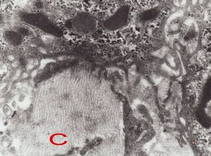 F,7m. | giant cell hepatitis-C-collagen fibers